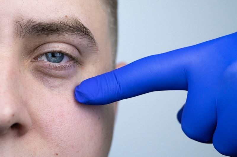 رفع سیاهی و گودی زیر چشم با تزریق ژل و فیلر