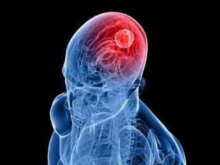 علائم و نشانه‌های هشداردهنده تومور مغزی
