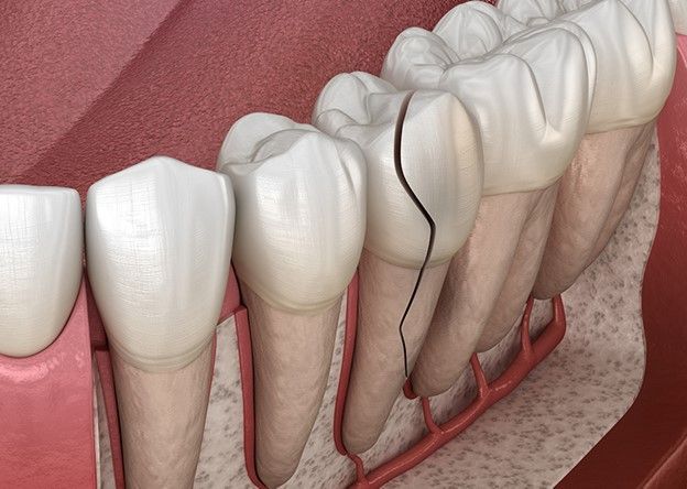 بهترین روش درمان شکستگی و ترک خوردگی دندان چیست؟