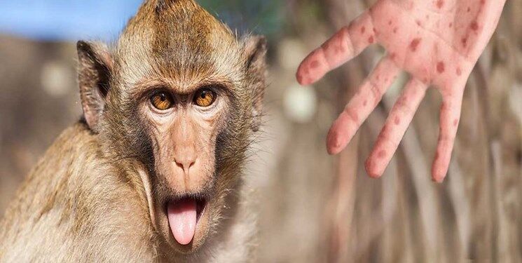 نگرانی سازمان جهانی بهداشت درباره سویه جدید آبله میمونی
