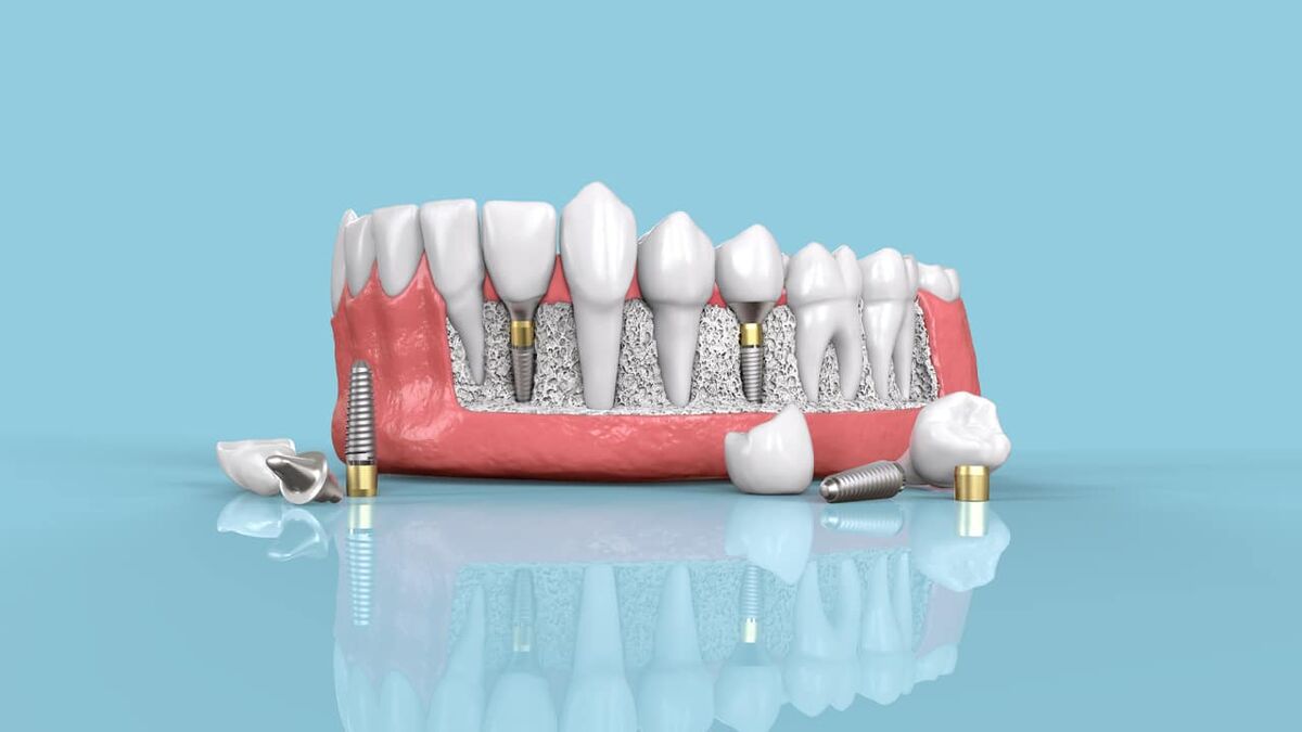 هزینه انواع ایمپلنت دندان