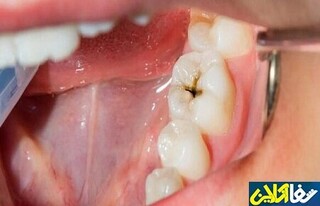 مراقب خوراکی‌های اسیدی باشید؛ دندان‌هایتان را نابود می‌کنند