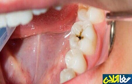 مراقب خوراکی‌های اسیدی باشید؛ دندان‌هایتان را نابود می‌کنند
