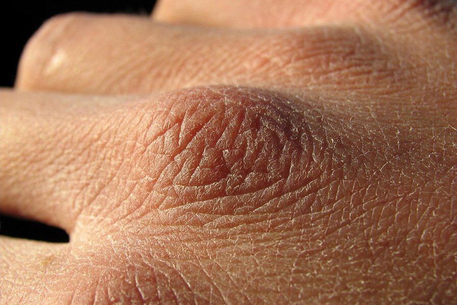 چگونه خشکی پوست را درمان کنیم؟