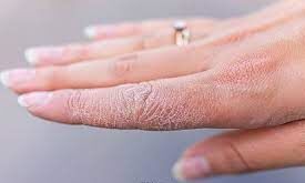 چگونه خشکی پوست را درمان کنیم؟