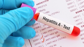 آخرین آمار از مبتلایان به هپاتیت A در کشور