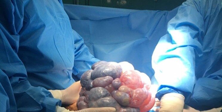 جراحی منحصر بفرد کودک ۱۱ ساله در بیمارستان مفید+فیلم