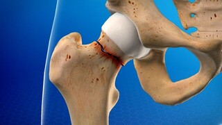 ابتلای ۴۷ درصد زنان بالای ۵۰ سال ایرانی به کمبود تراکم استخوان