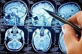 زمان طلایی برای درمان بیماران سکته مغزی ۳ تا ۶ ساعت است