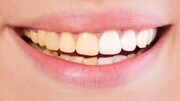 ۷ دلیل اصلی زرد شدن دندان‌ها؛ چه باید کرد؟