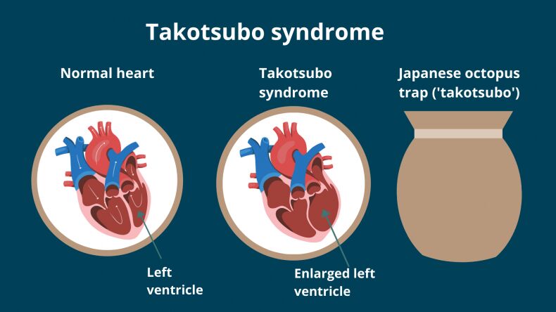 وقتی شخصی می گوید "قلبم شکست" چه تاثیر فیزیکی بر قلب او دارد ؟/هر آنچه باید درباره سندروم تاکوتسوبو بدانید