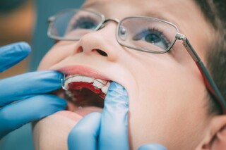 بهترین سن ارتودنسی کردن دندان کودکان چه زمانی است؟