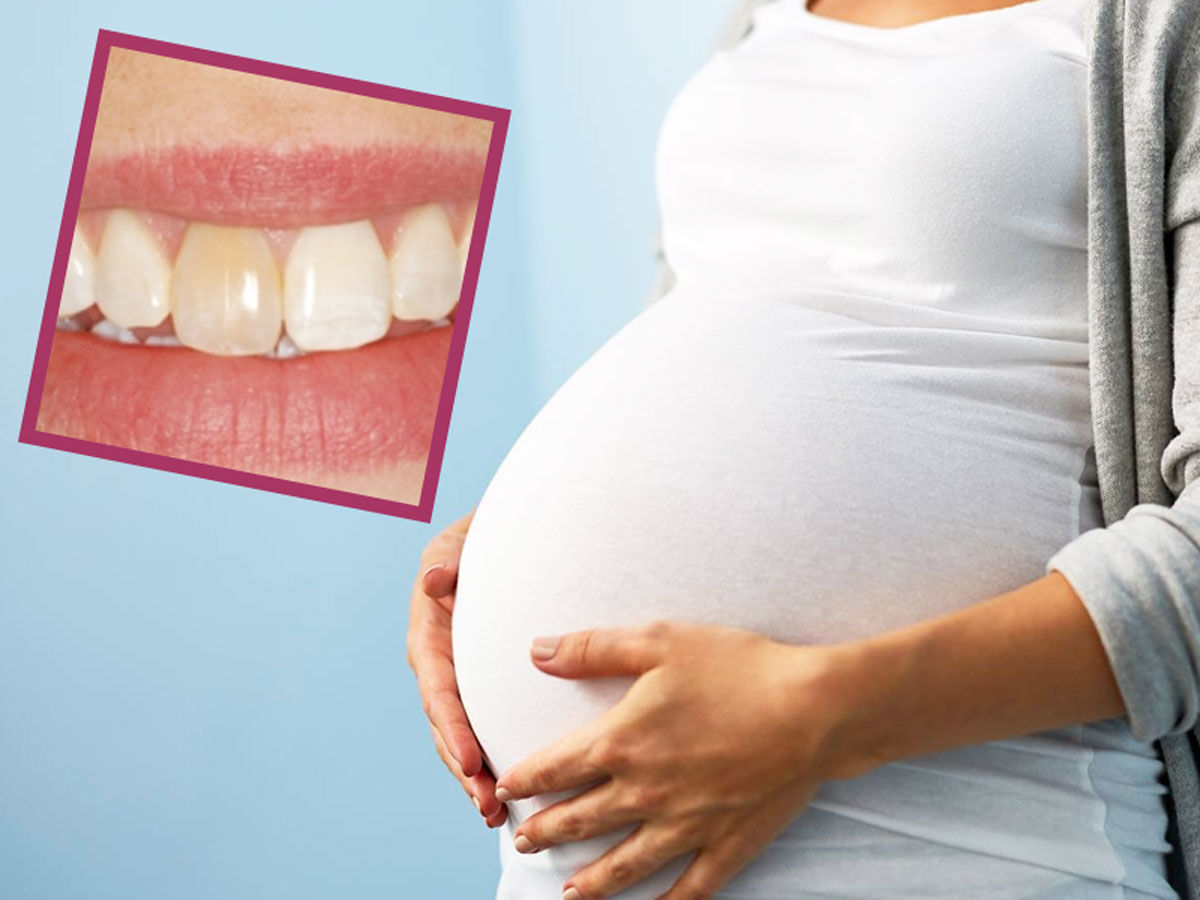 باورهای غلط درباره خراب شدن دندان‌های مادران باردار