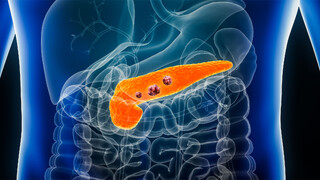 محققان اعلام کردند؛ یک خبر خوب درباره سرطان پانکراس