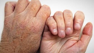 هنوز ترس غیرطبیعی در جامعه نسبت به بیماری جذام وجود دارد