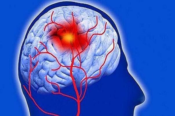 گاز رادون خطر سکته مغزی را افزایش می دهد