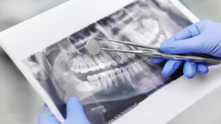 کاهش مراجعات مردم به دندانپزشکان/ افزایش ۷۰۰ تا ۸۰۰ درصدی قیمت محصولات دندانپزشکی