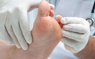 زخمهای دیابتی با کمک نانومیله طلا و هیستامین درمان میشود