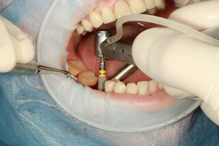 ۶ مزیت ایمپلنت دندان/ چرا دندانپزشکان برای پرکردن دندان از دست‌رفته روی «ایمپلنت» اصرار می‌کنند؟