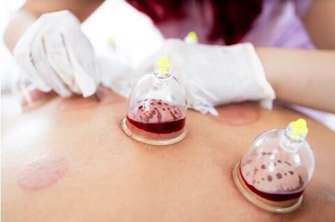 درمانهای ترسناک؛ از طب سوزنی روی زبان تا بادکش های داغ