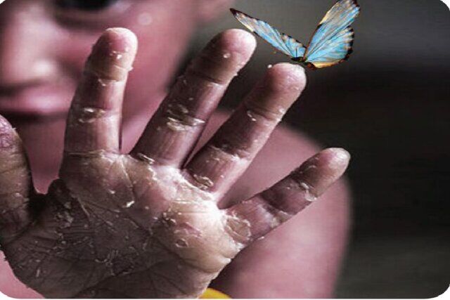 تخمین حضور حدود ۳میلیون بیمار نادر در کشور / لزوم تقویت زنجیره تامین داروی این بیماران تخمین حضور حدود ۳میلیون بیمار نادر در کشور / لزوم تقویت زنجیره تامین داروی این بیماران