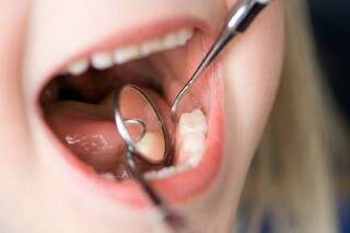 چگونه از پوسیدگی دندان جلوگیری کنیم؟