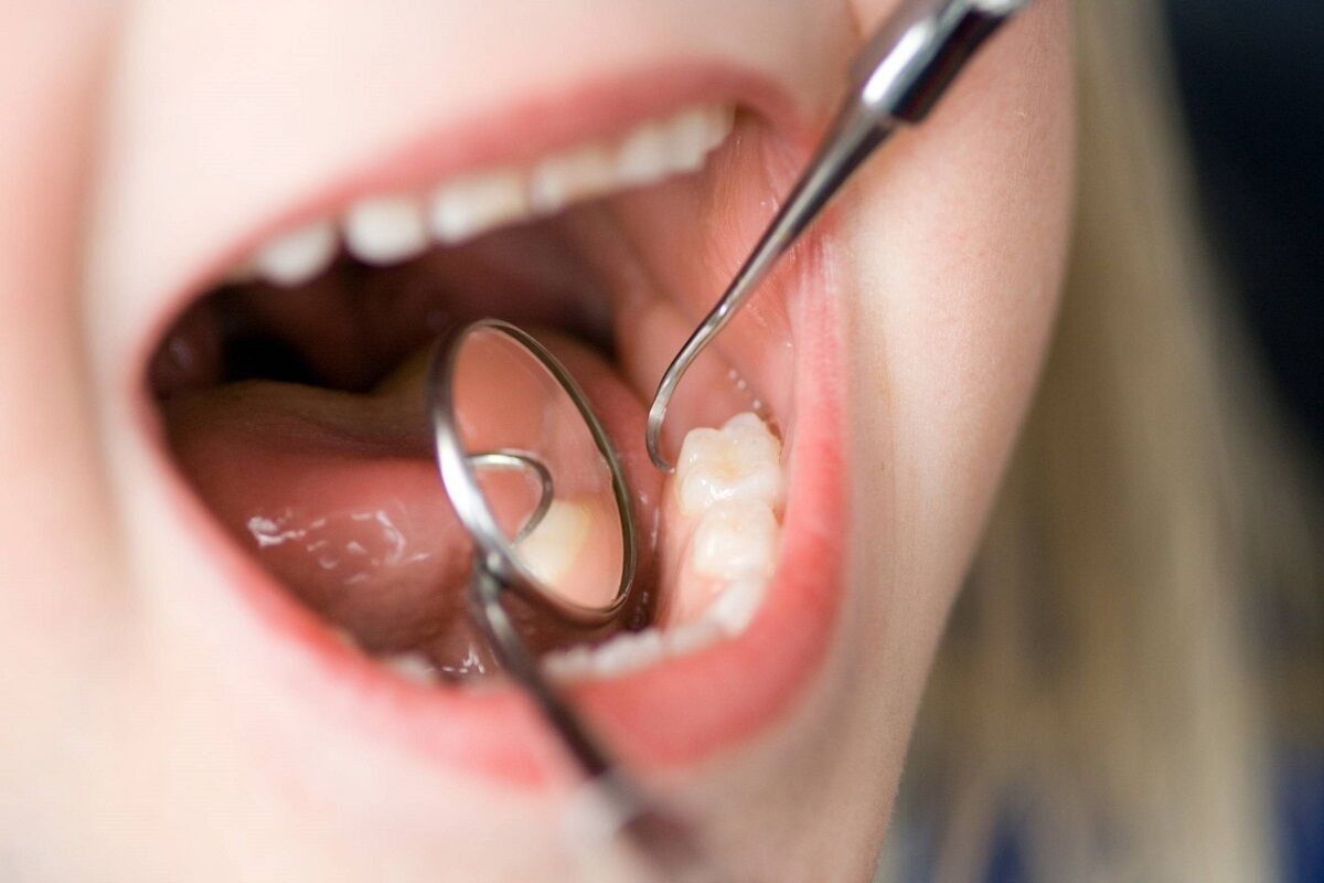 چگونه از پوسیدگی دندان جلوگیری کنیم؟