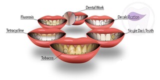 با تغییر رنگ دندان‌ها چه کنیم؟
