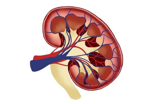 چگونه خطر سنگ کلیه را کاهش دهیم؟
