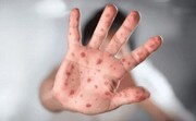 ضرورت واکسیناسیون مادران باردار برای مقابله با آبله‌مرغان