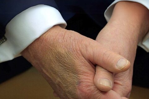 عکس | ترامپ بهزودی میمیرد؟ / تصویری از کبودیهای مشکوک رئیسجمهور آمریکا