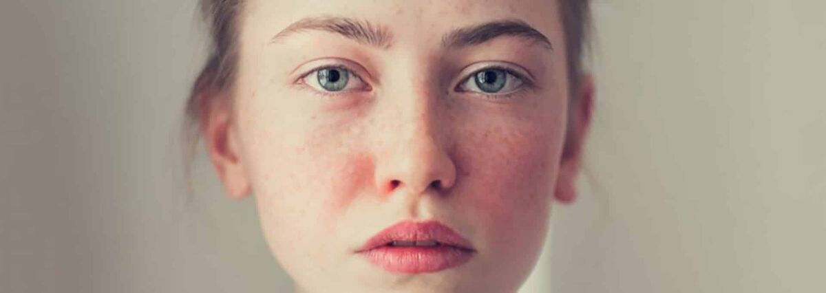 چرا پوست صورت بد رنگ می شود؟ / درمان خانگی برای طراوت پوست