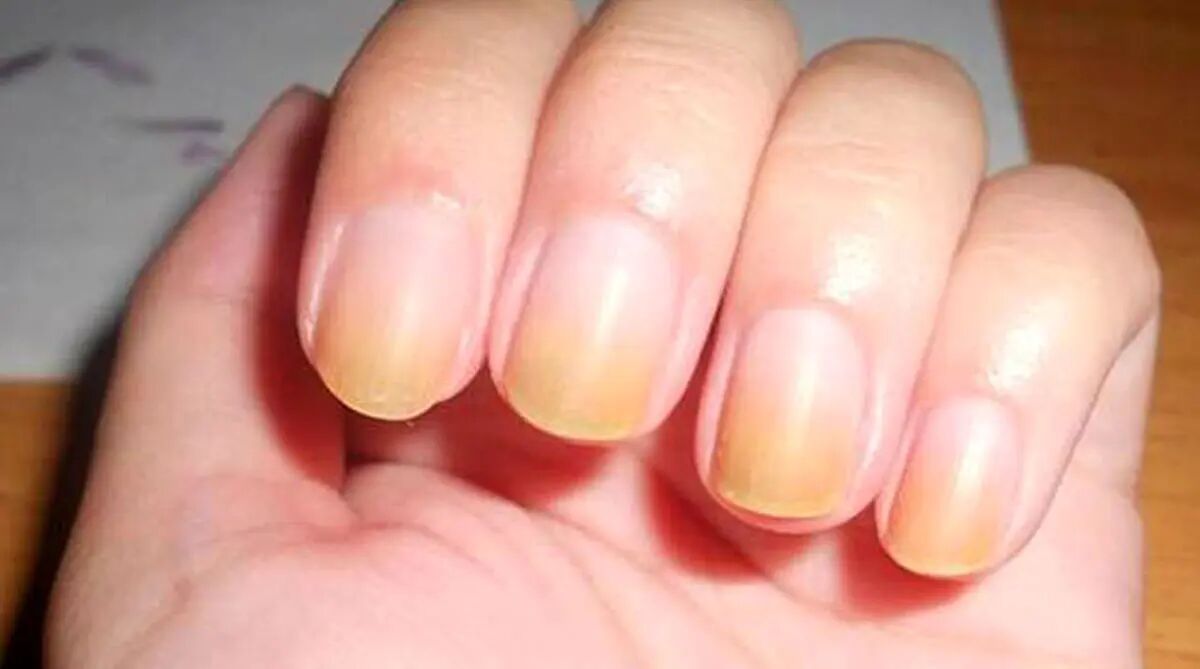 تغییر رنگ ناخن‌ها را جدی بگیرید
