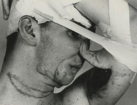 تاریخچه عملهای زیبایی/ اولین جراحی زیبایی تاریخ چه زمانی انجام شد؟