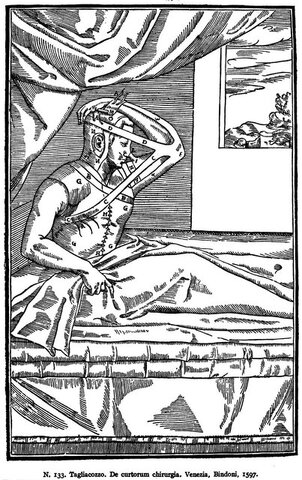 جراحی پلاستیک: پیوند از بازو به بینی، قرن ۱۶ منبع عکس: wellcomecollection