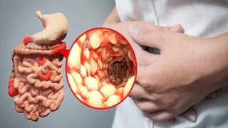 تغذیه نامناسب علت ۴۵ درصد بیماری‌های شدید گوارشی است