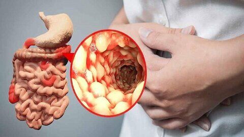 تغذیه نامناسب علت ۴۵ درصد بیماری‌های شدید گوارشی است