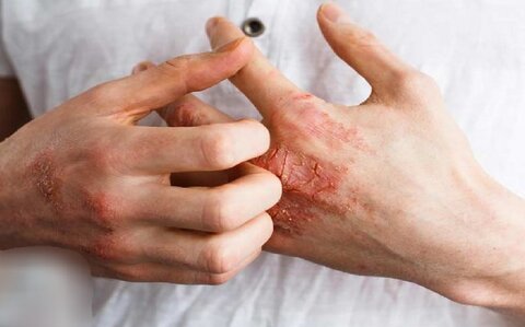بهره مندی دو هزار بیمار سلیاکی از خدمات درمانی در مشهد