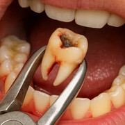 ۵ عامل اصلی در تعیین هزینه کشیدن دندان در سال ۱۴۰۴