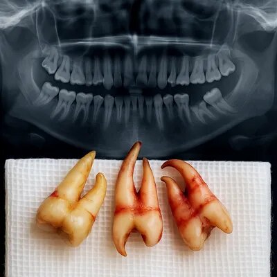 5 عامل اصلی در تعیین هزینه کشیدن دندان در سال 1404