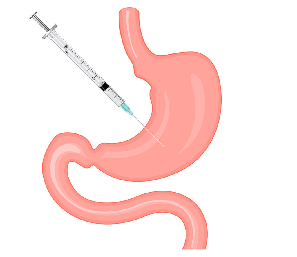آیا بوتاکس معده چاق‌ها را لاغر می‌کند؟