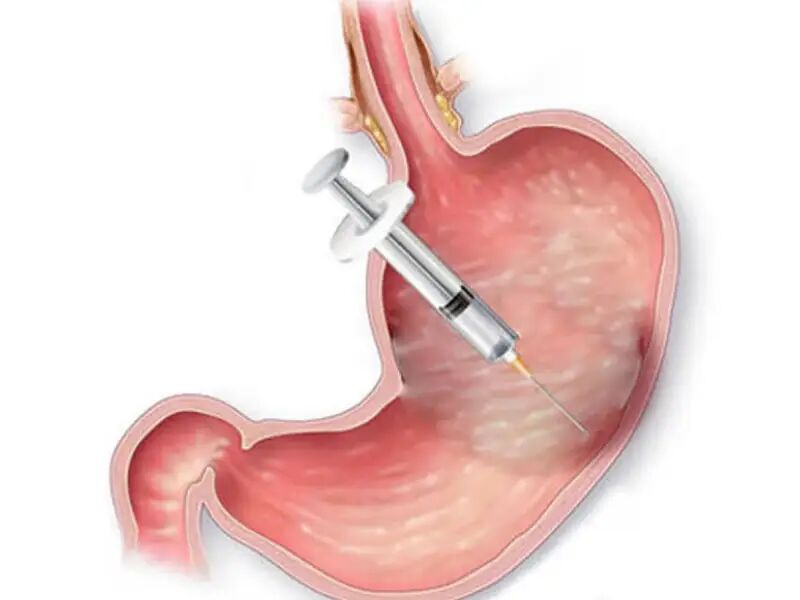 هشدار متخصصان جراحی لاغری/ بوتاکس معده؛ روشی غیراستاندارد و پرعارضه برای کاهش وزن