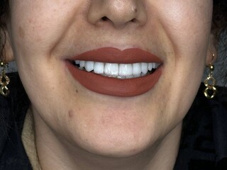 لمینت دندان در شیراز؛ قیمت، مزایا و بهترین کلینیک برای انجام آن