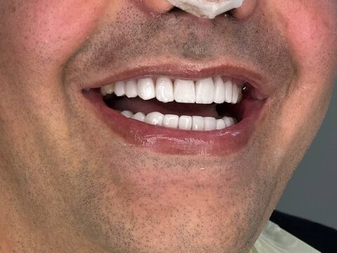 لمینت دندان در شیراز؛ قیمت، مزایا و بهترین کلینیک برای انجام آن