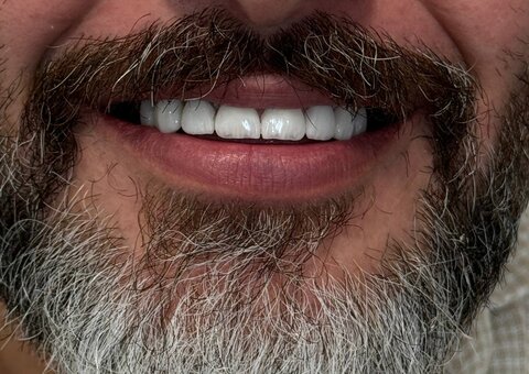 لمینت دندان در شیراز؛ قیمت، مزایا و بهترین کلینیک برای انجام آن