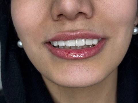 لمینت دندان در شیراز؛ قیمت، مزایا و بهترین کلینیک برای انجام آن