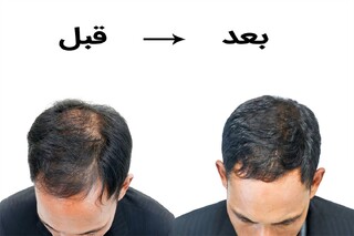 معجزه طب سنتی در رفع ریزش مو؛ از افسانه تا واقعیت
