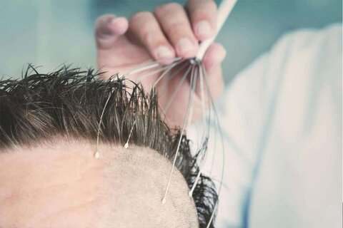 معجزه طب سنتی در رفع ریزش مو؛ از افسانه تا واقعیت