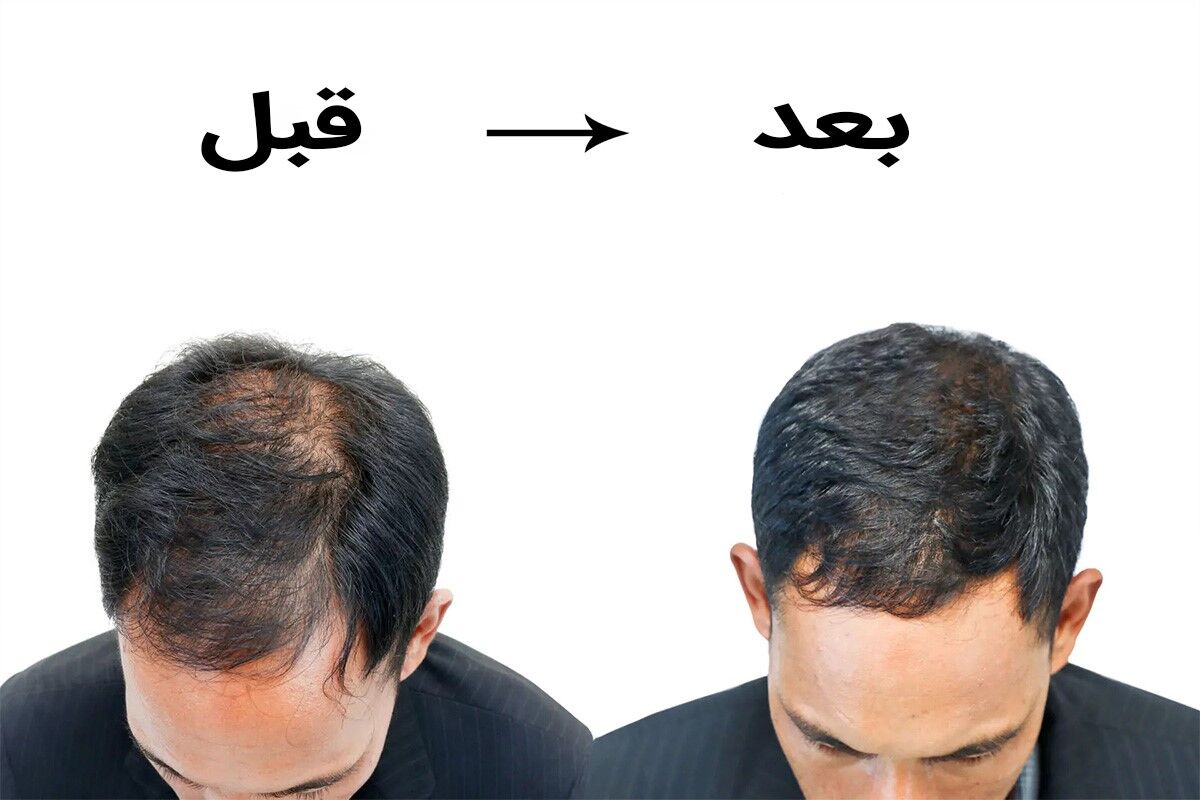 معجزه طب سنتی در رفع ریزش مو؛ از افسانه تا واقعیت
