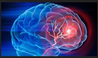 ۴ ساعت نخست؛ زمان طلایی نجات بیماران سکته مغزی